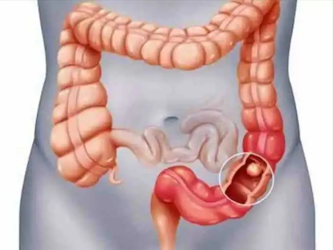 நெஞ்செரிச்சல் பிரச்சனைக்கு தீர்வு தரும் ஜூஸ் வகைகள்